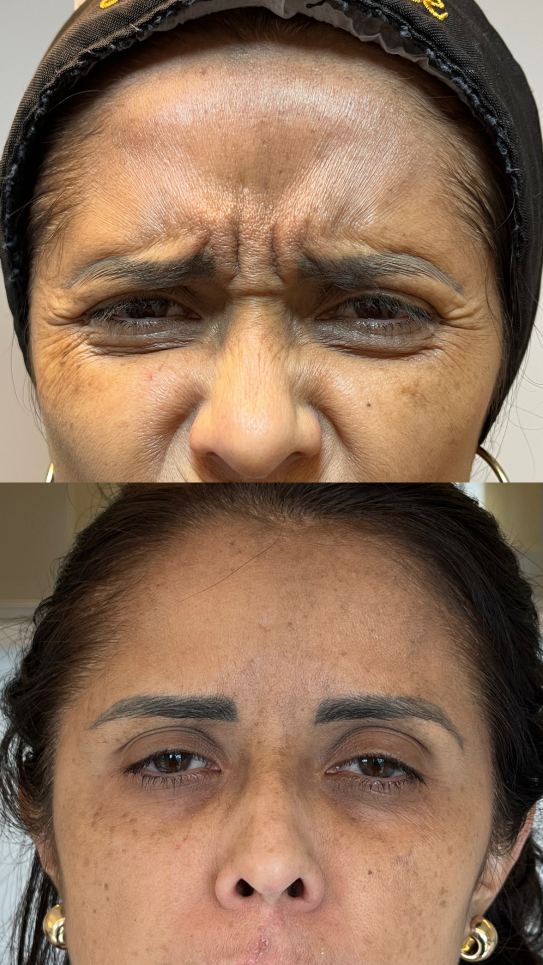 Antes e depois — Glabela e expressão