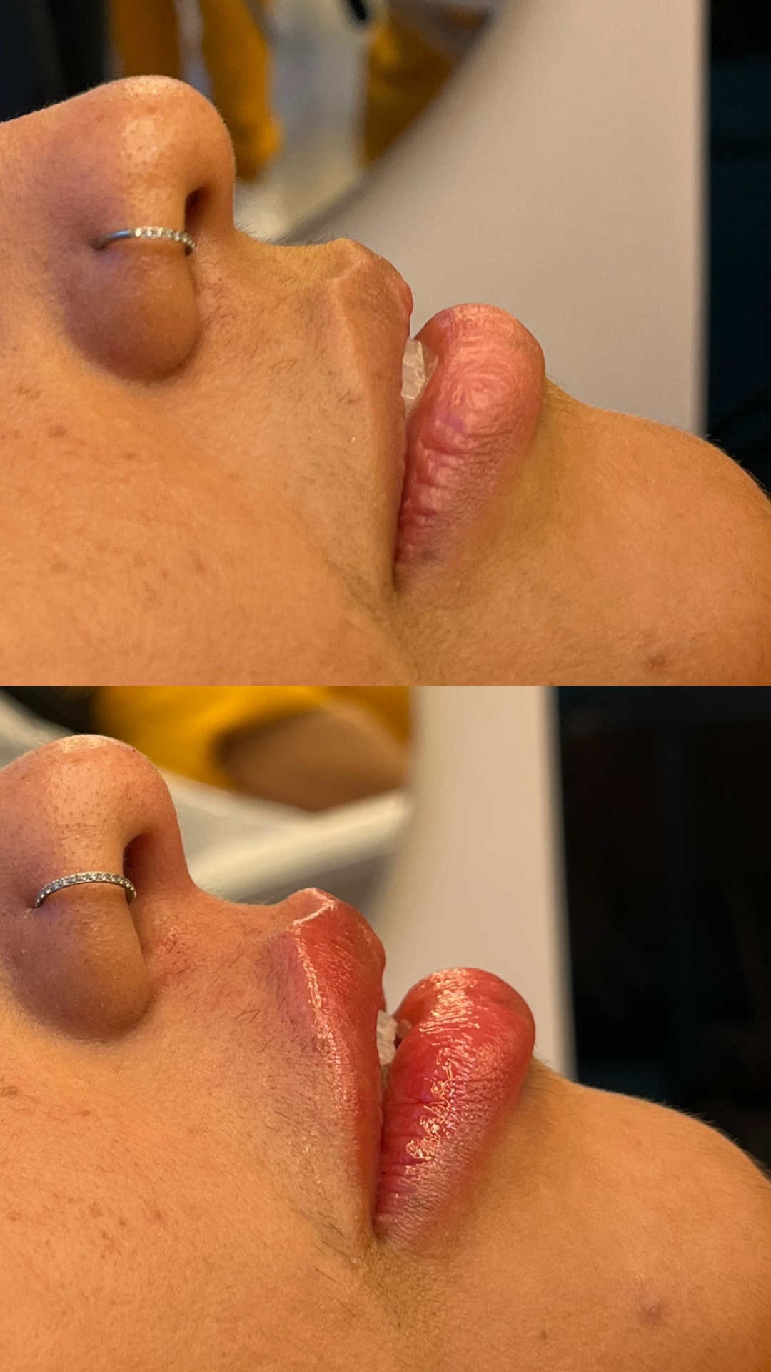 Antes e depois — Hidratação labial