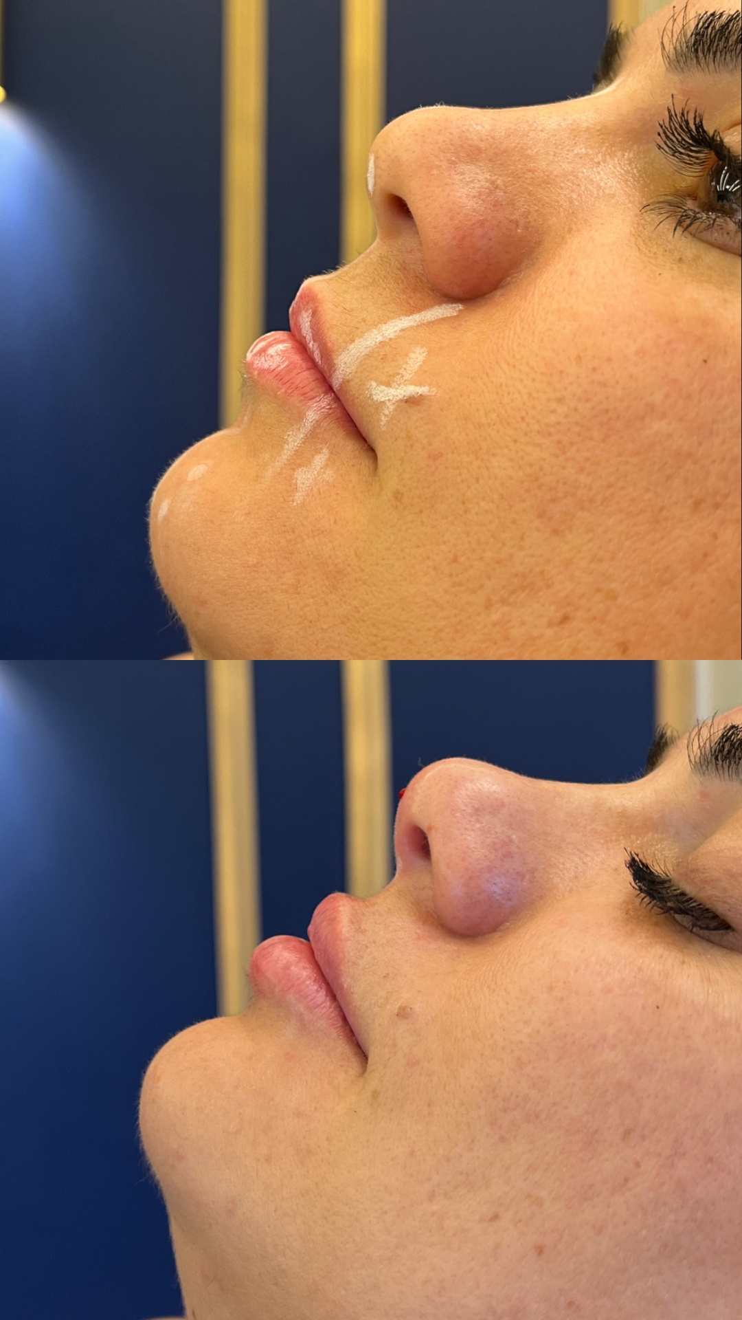 Antes e depois — Contorno labial