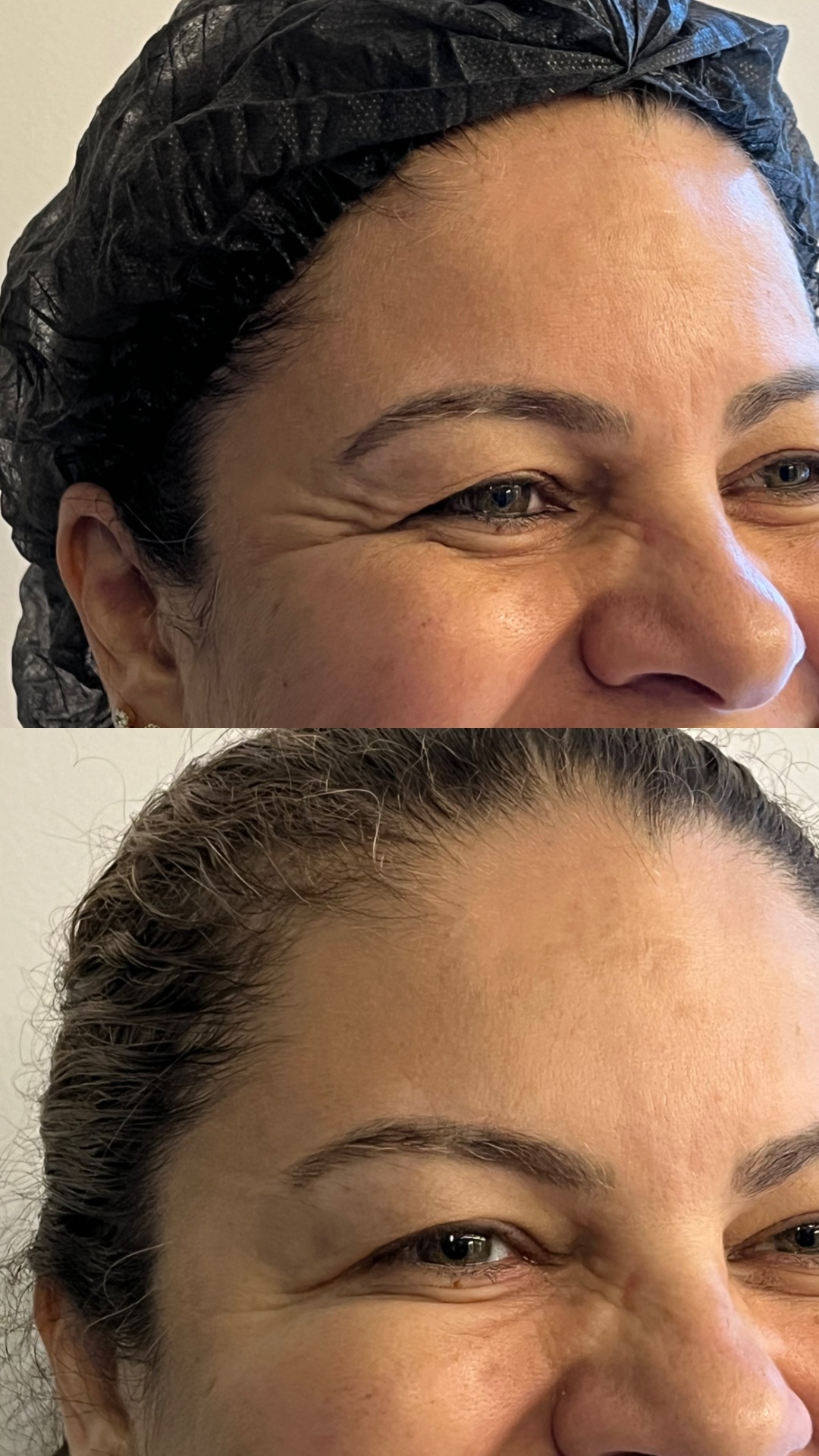 Antes e depois — Pés-de-galinha