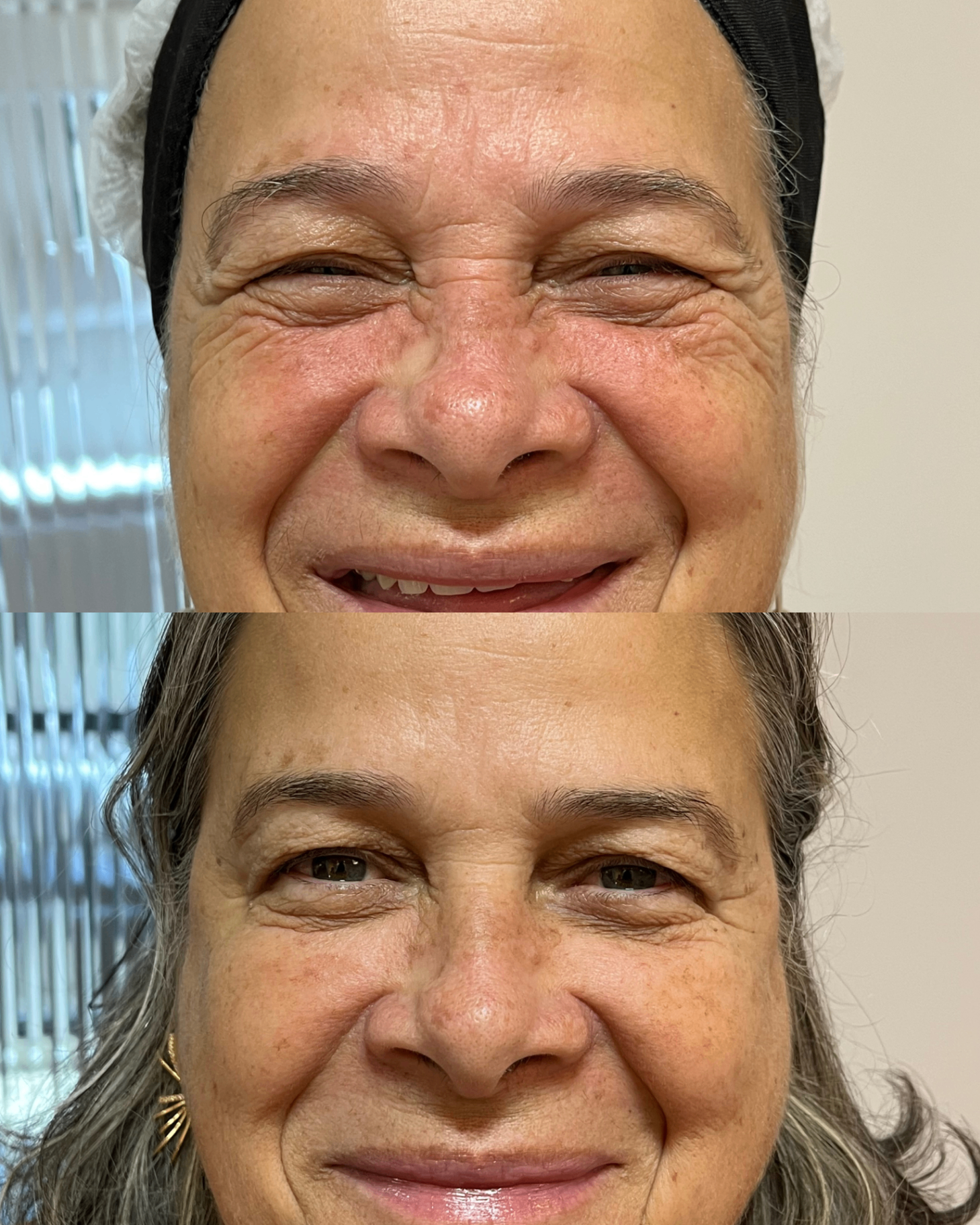 Antes e depois — Olhar descansado