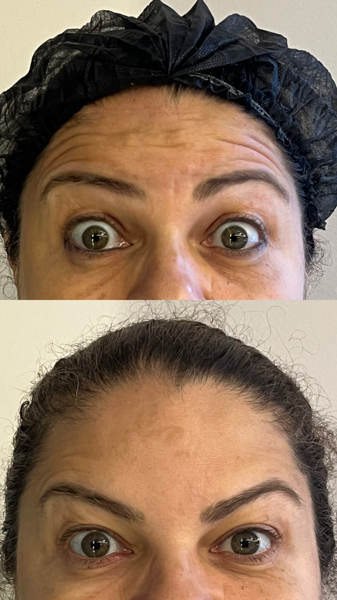 Antes e depois — Linhas da testa